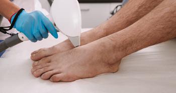 feet laser hair removal